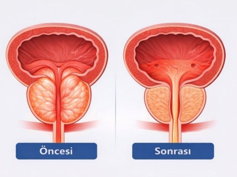 benign-prostat-hiperplazisi-tedavi-fiyatlari-2026